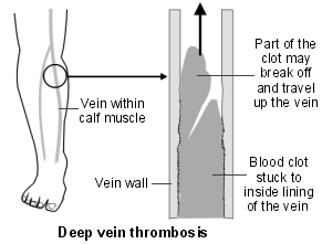 Schema des Beins mit Venen und einer tiefen Venenthrombose