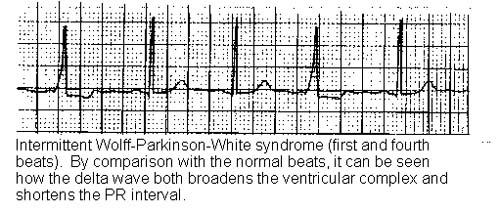 WOLFF-PARKINSON-WHITE-SYNDROM