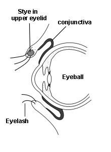 Querschnittsdarstellung eines Auges mit einem Stye im oberen Augenlid