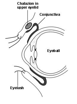 Chalazion im oberen Augenlid