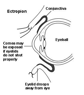Querschnittsdarstellung eines Auges mit Ektropium