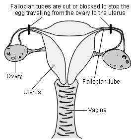 Sterilisation der Frau