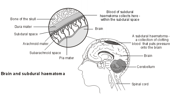 subdurales Hämatom