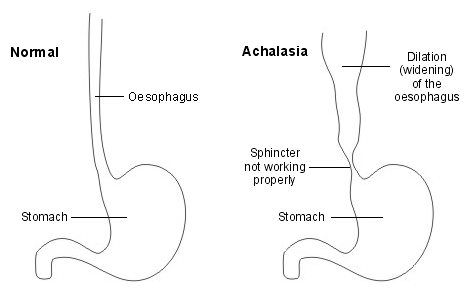 Achalasie