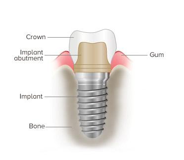 Bild eines Zahnstocherimplantats