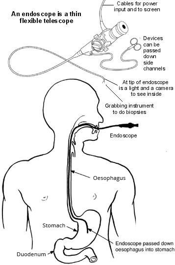Gastroskopie