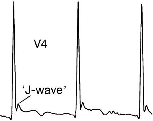 HYPOTHERMIE-EKG