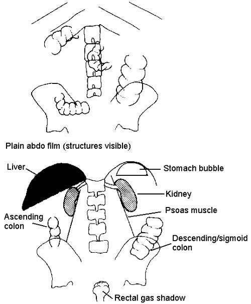 ABDOMINALRÖNTGEN