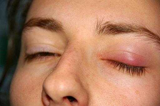 chalazion