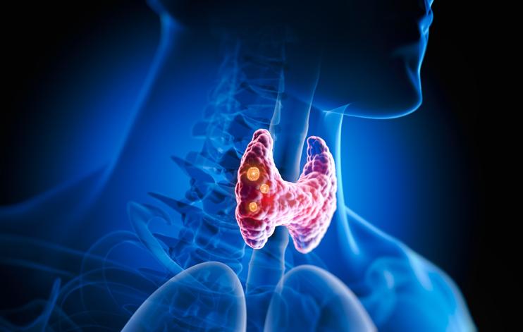 Unterfunktion der Schilddrüse