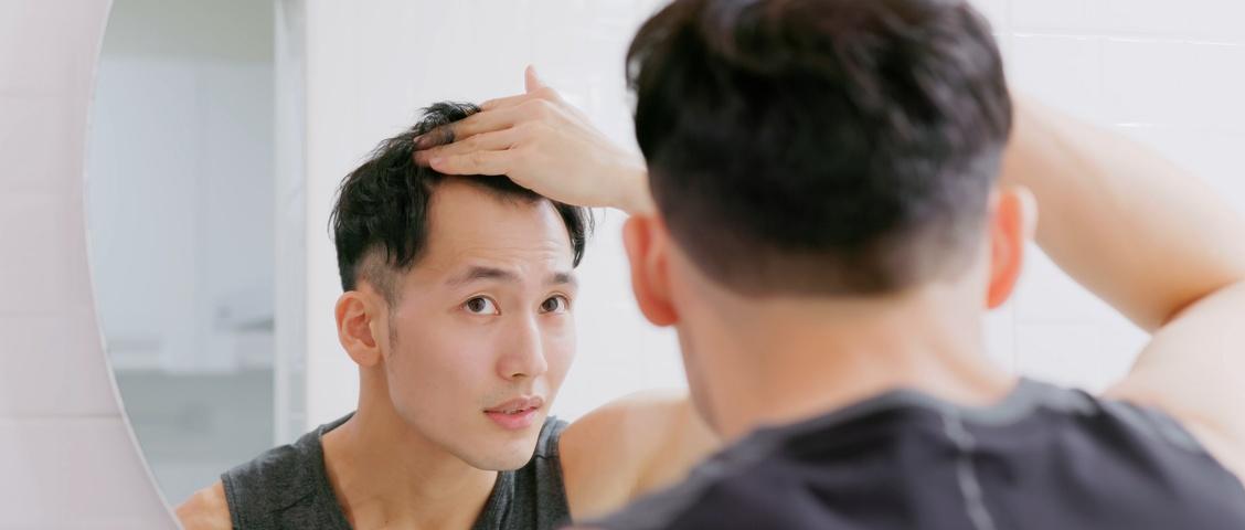 Mann steht vor dem Spiegel und ist besorgt über Haarausfall oder Alopezie