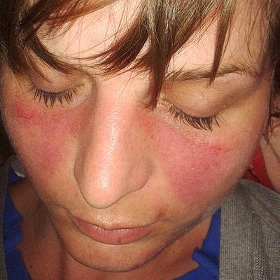 Photo of face with lupus