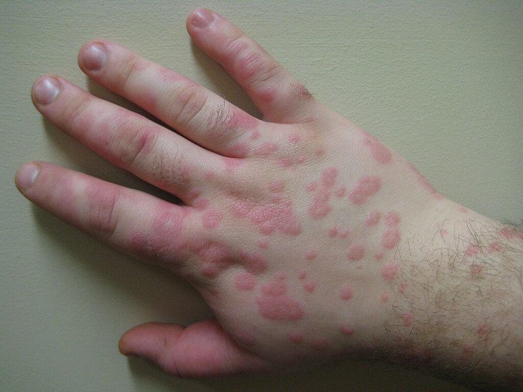 Foto von Erythema multiforme an der Hand