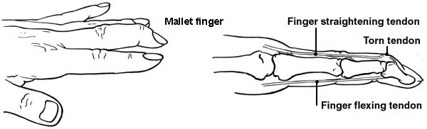 Diagramm der Hand mit Schlegelfinger