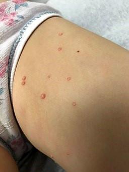 Molluskum contagiosum