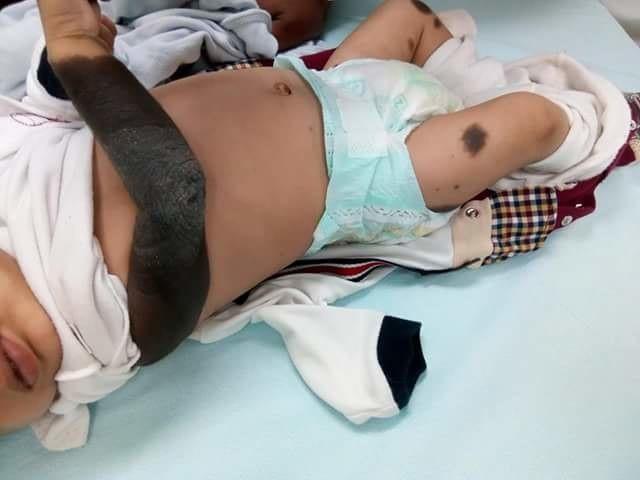 Kongenitaler melanozytärer Naveus