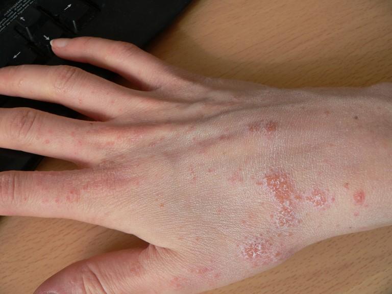 Krätzeausschlag an der Hand