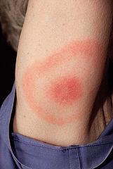 Borreliose Erythema migrans