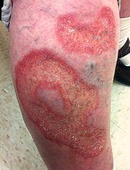 Nekrobiose lipoidica