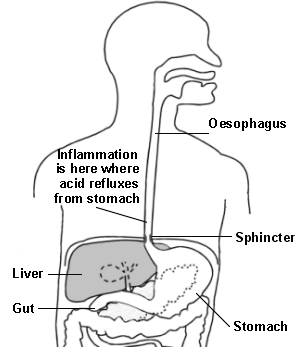 Entzündung des sauren Refluxes