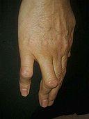 Deformierung der Boutonniere