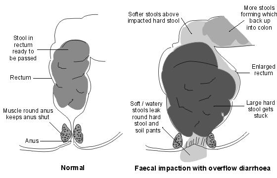 Chronische Verstopfung