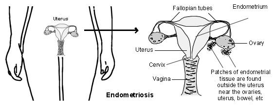 Endometriose