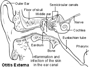 Das Ohr - Otitis externa
