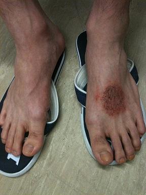 Lichen simplex auf dem Fußrücken eines jungen Mannes