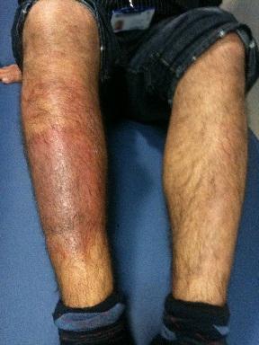 Lichen simplex am Schienbein eines jungen Mannes