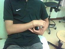 Colles-Fraktur von außen. Kein Röntgenbild