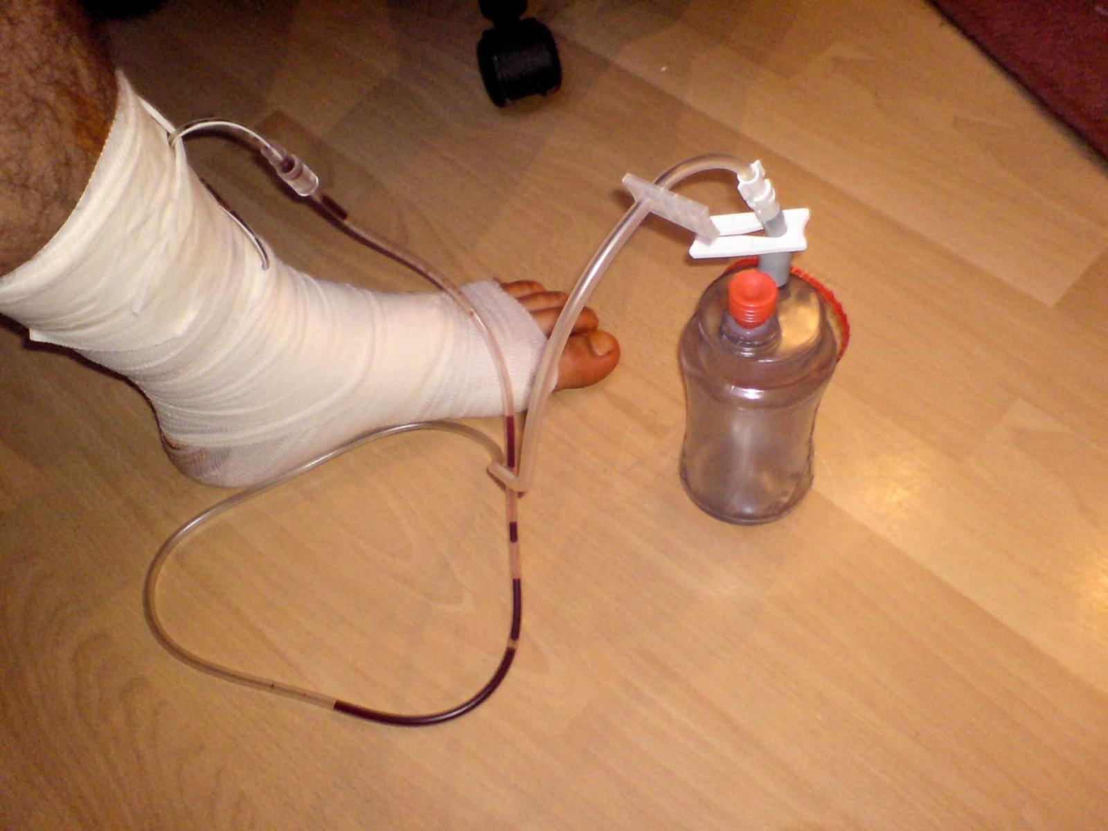 Bild der chirurgischen Beindrainage mit freiem Zugang