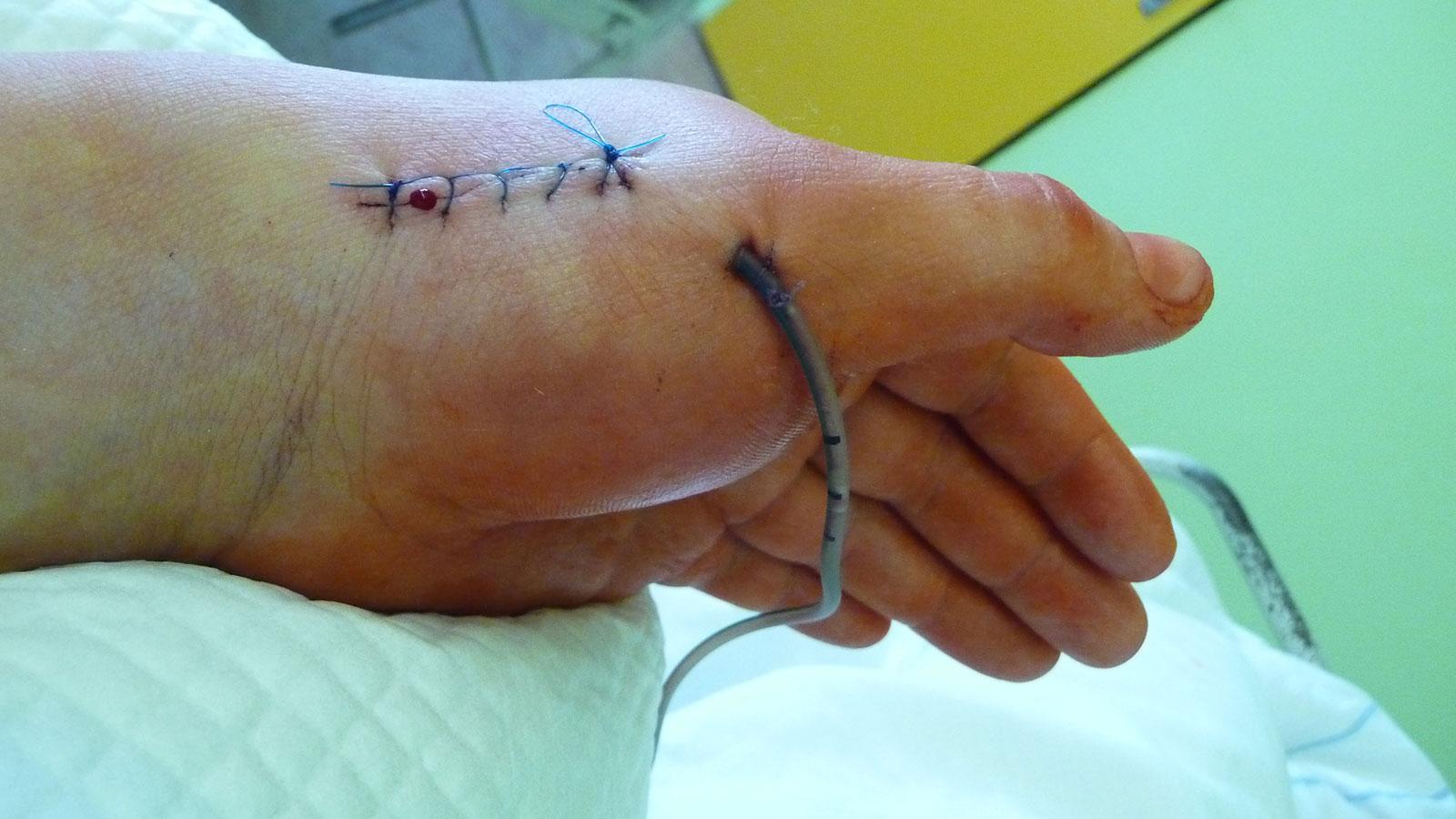 Handchirurgische Drainage mit offenem Zugang