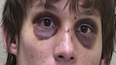 Bilaterale periorbitale Ekchymose