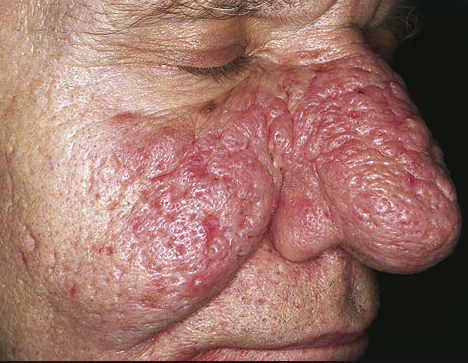 Rhinophym