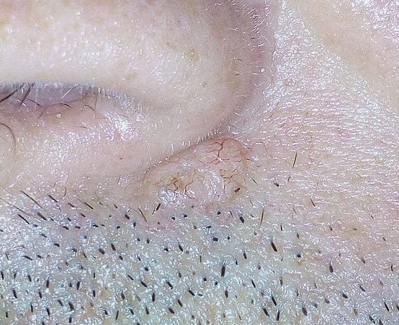 Basal cell carcinoma under the nose