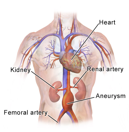 Abdominales Aortenaneurysma