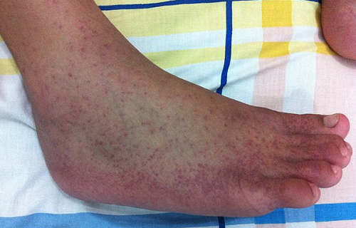 Chikungunya rash