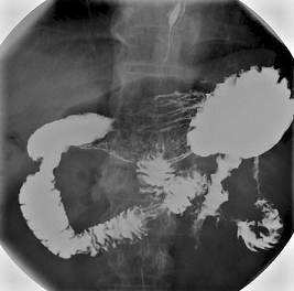 Barium meal stomach
