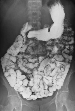 Barium follow through