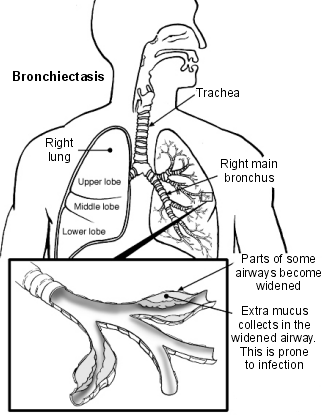 Lunge und Atemwege bei Bronchiektasien