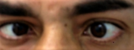 VI and XII Cranial Nerve Palsies