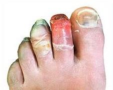 Frostbite 12 days post-injury