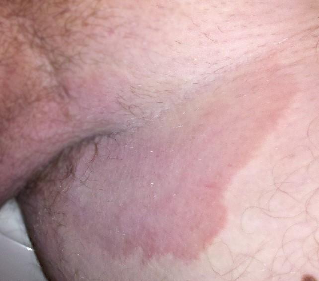 tinea cruris pictures