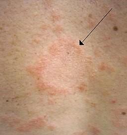 Pityriasis rosea Vorbote