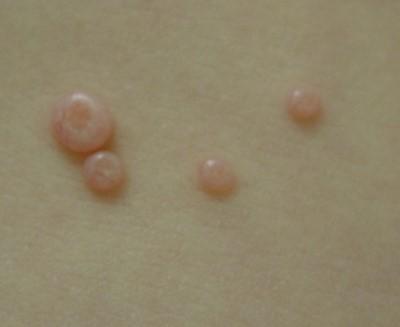 Molluskum contagiosum