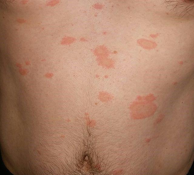Pityriasis rosea Bilder