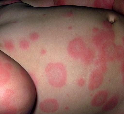 Erythema multiforme
