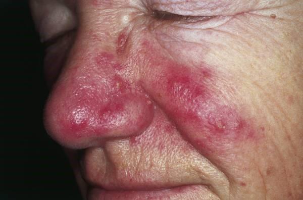 Rosacea auf Nase und Wangen