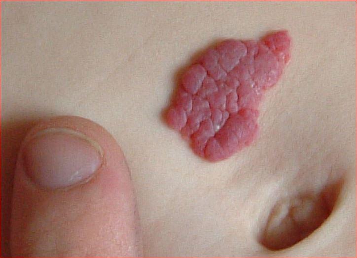 Hämangiom - Erdbeer-Naevus